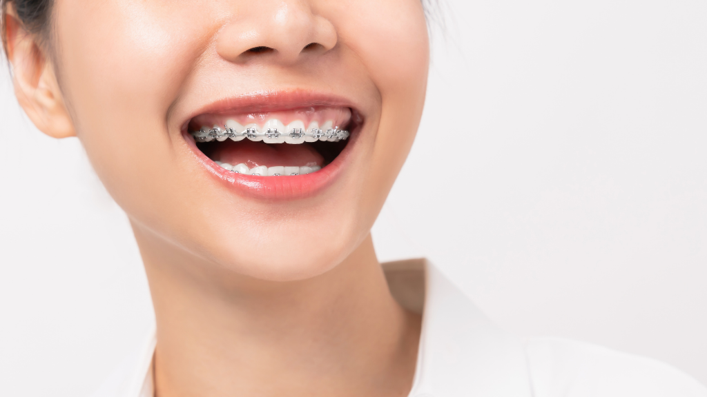 Braces 101: A Friendly Guide to Transforming Your Smile