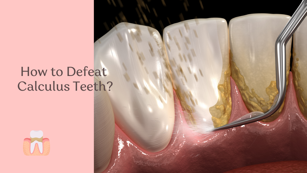 Healthy Teeth: How to Defeat Calculus Teeth