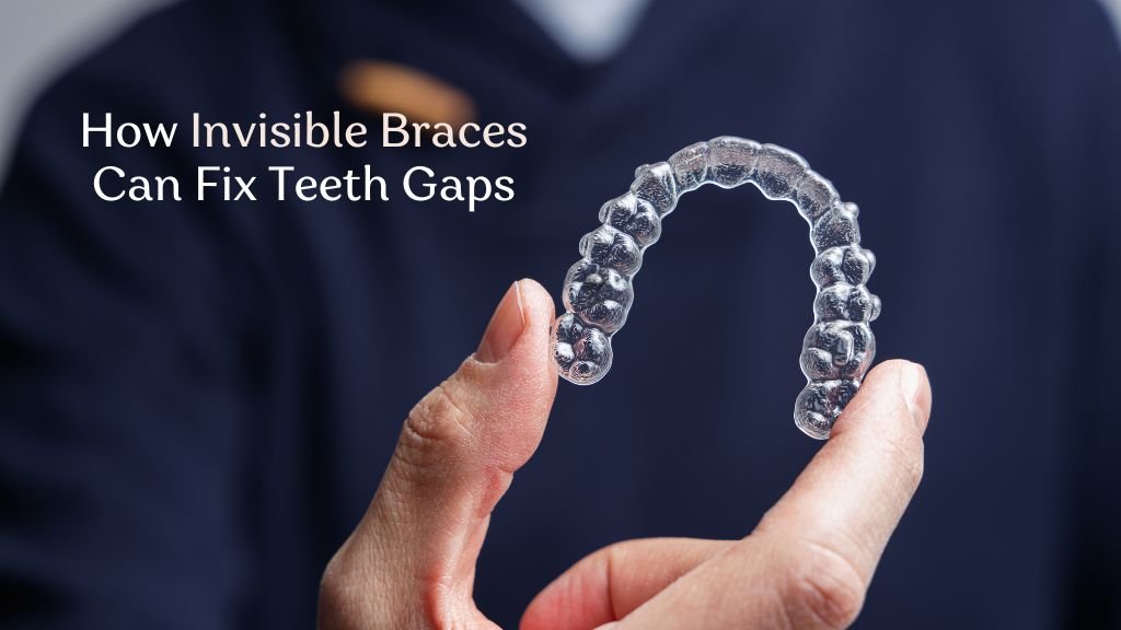 Invisible Braces