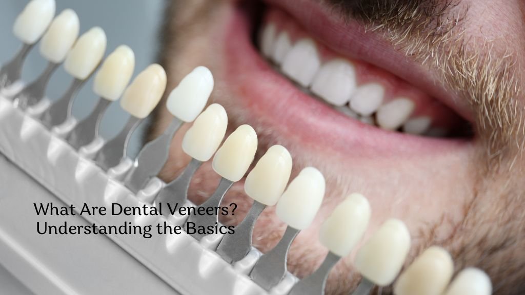 What Are Dental Veneers? Understanding the Basics